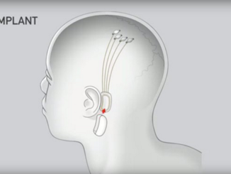 Neuralinkl